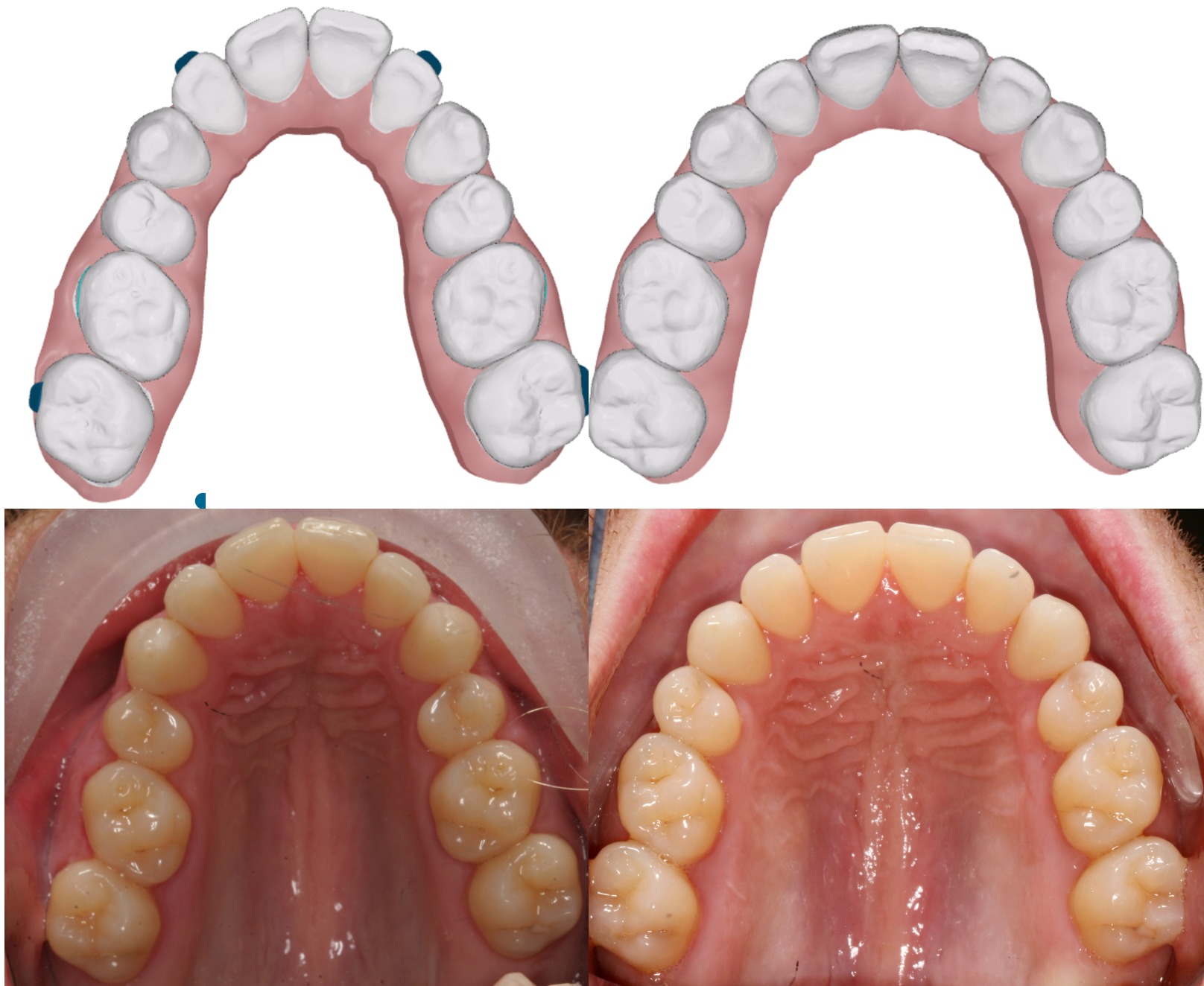 Side-by-side upper arch models and dental photographs