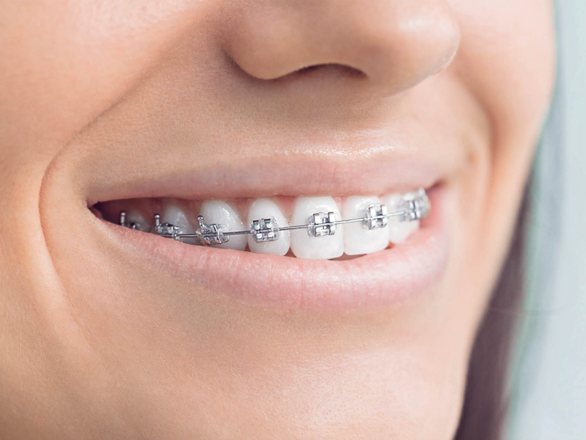 Close-up of a smile with metal braces