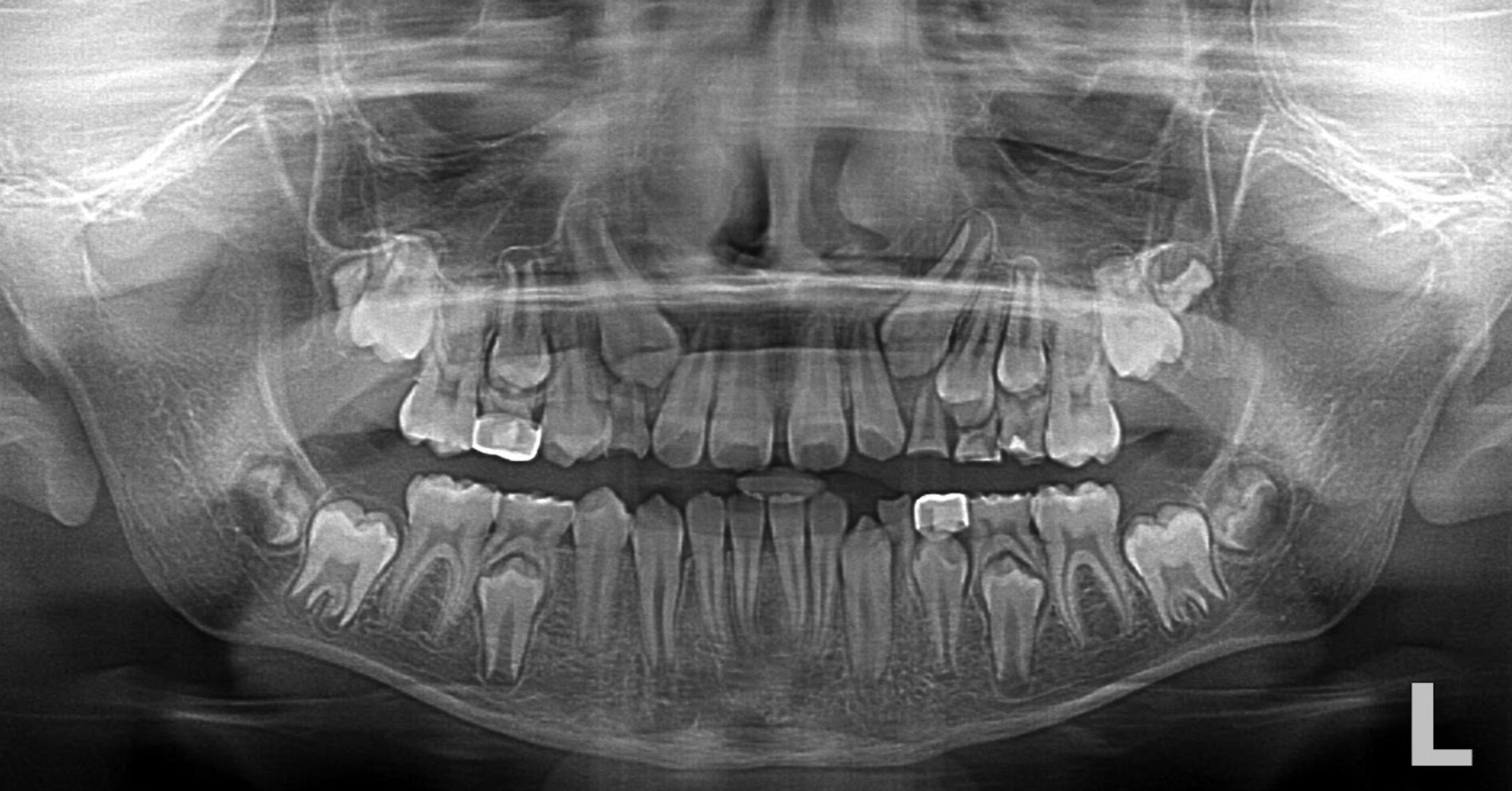 Panoramic dental radiograph showing developing teeth