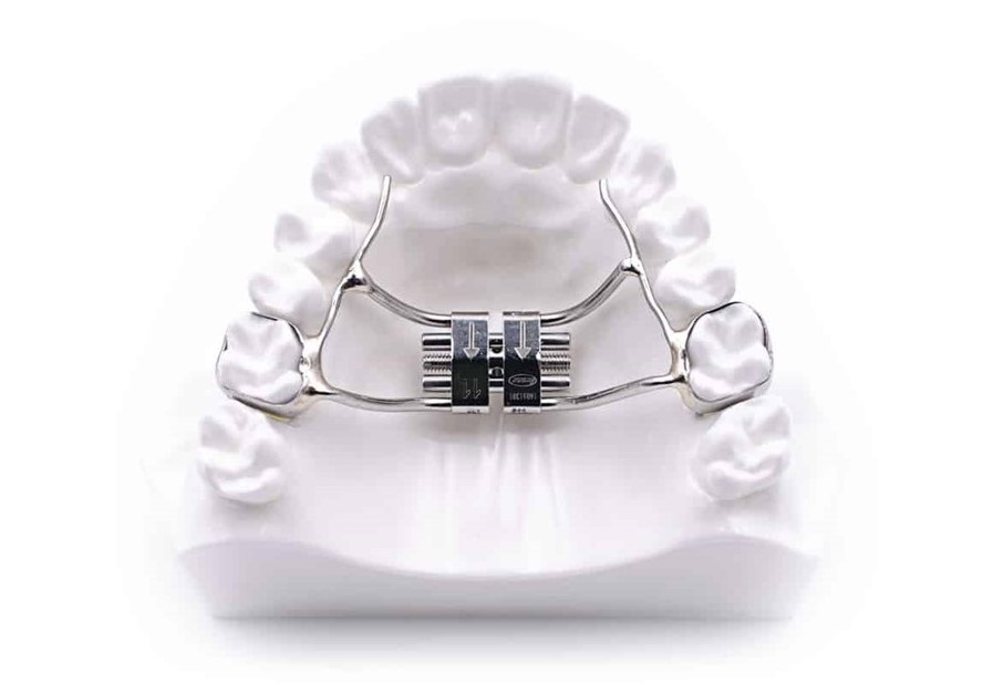 Tooth-borne Hyrax expansion appliance on a dental model