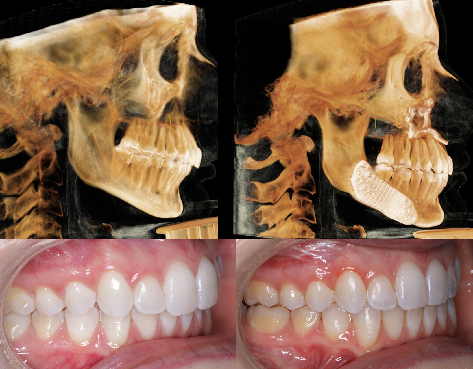 Side-by-side jaw scans and bite photographs