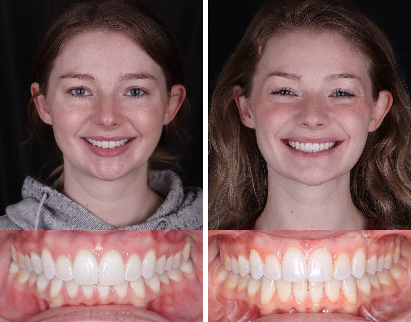 Side-by-side frontal smile and bite photographs