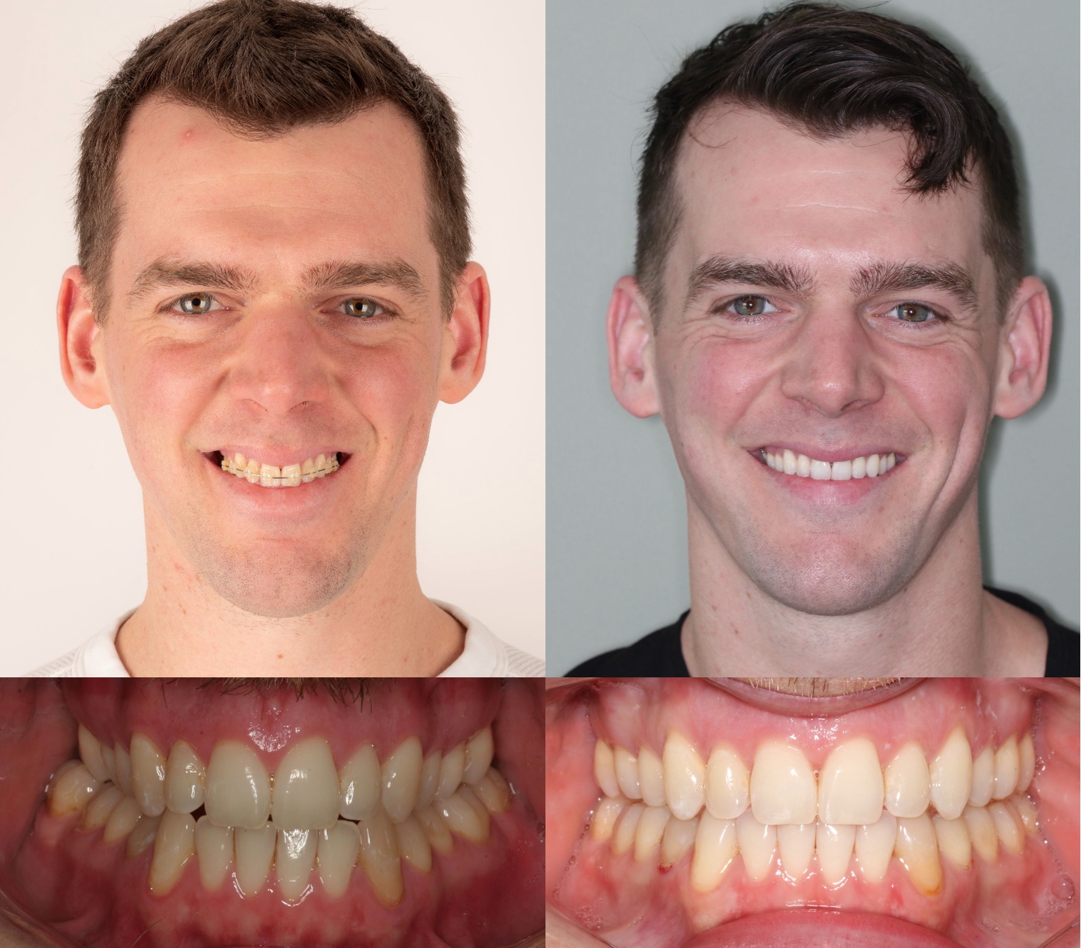 Side-by-side frontal smile and bite photographs